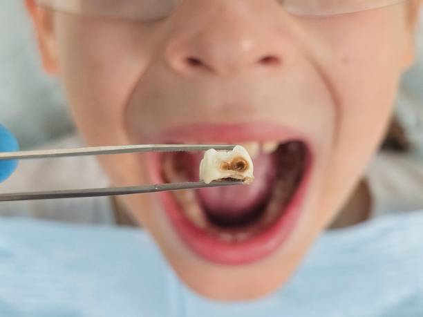 Best Emergency Dental Extractions in St Paul, TX